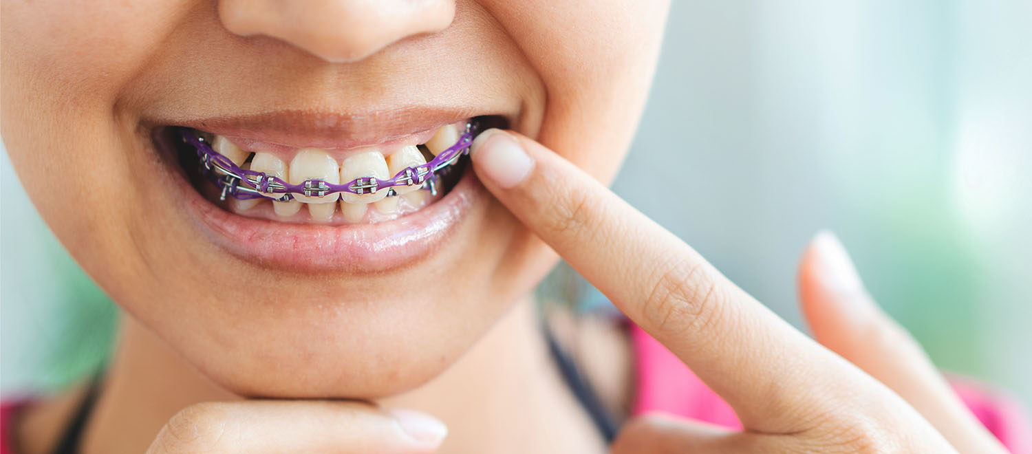 Problems with Ceramic Braces: 3 Things to Consider Before You Commit