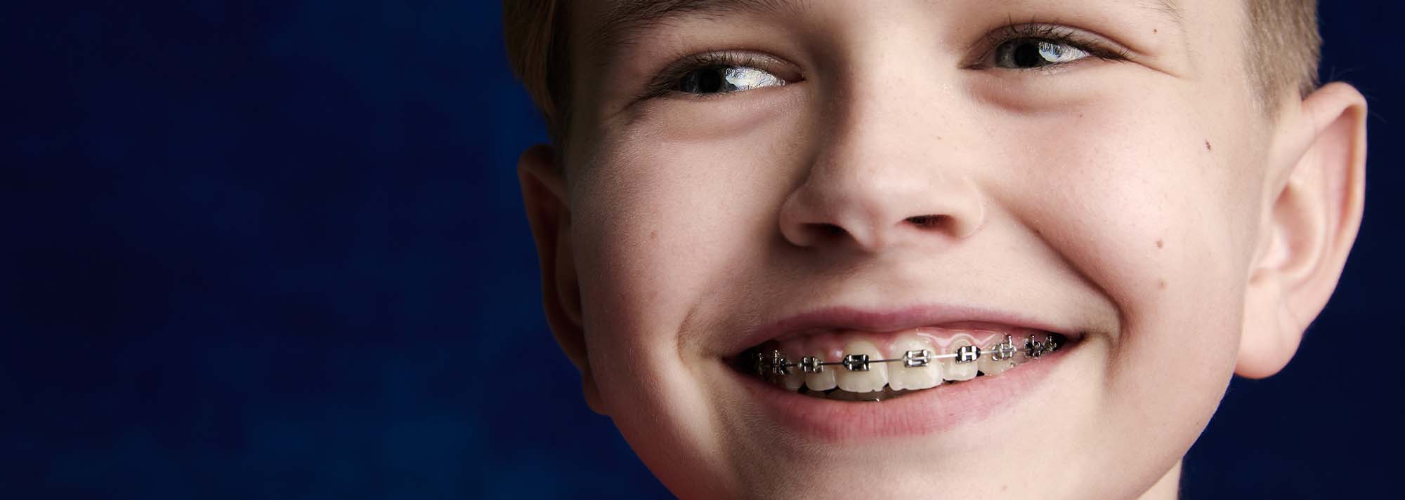 Braces orthodontic treatment offered by Smile Doctors